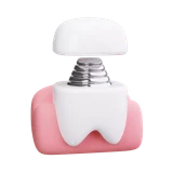 Implant Orthodontic Prosthesis Dental Care Tooth
